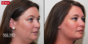 Kybella: Before and After