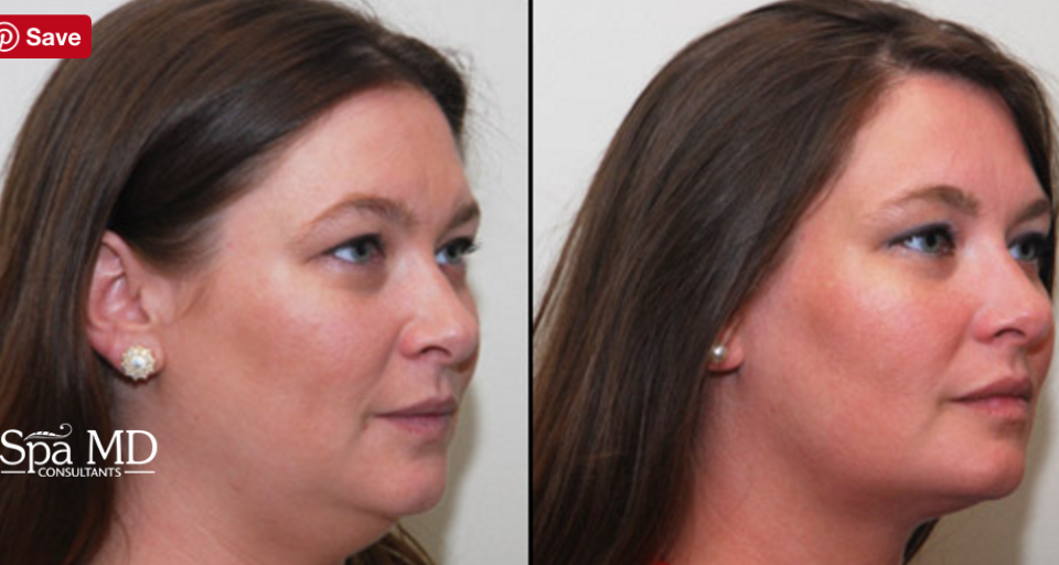 Kybella: Before and After