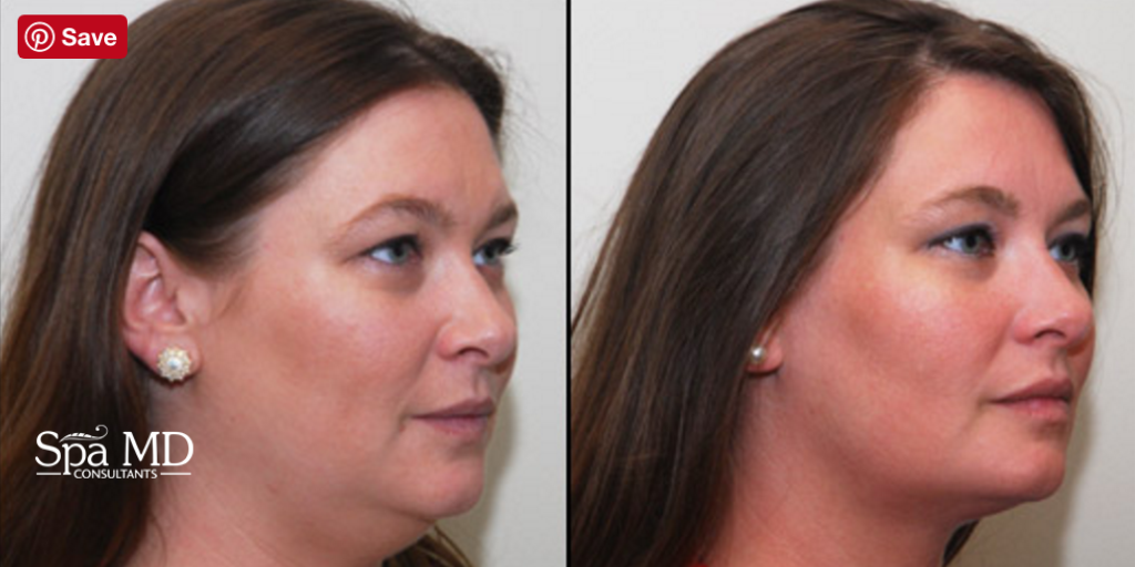 Spa MD Kybella Before and After - Spa MD.