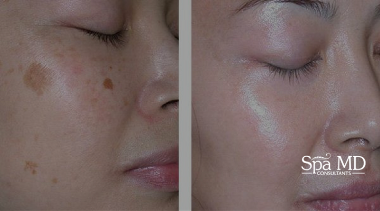 Removing Brown Spots On Faces Spa Md
