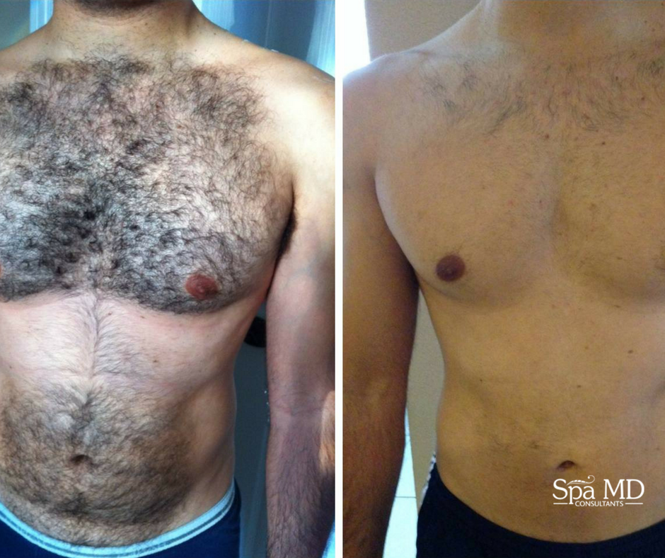 Hair Removal for Men: Grooming and Hair Removal Tips - Laser Spa In NYC