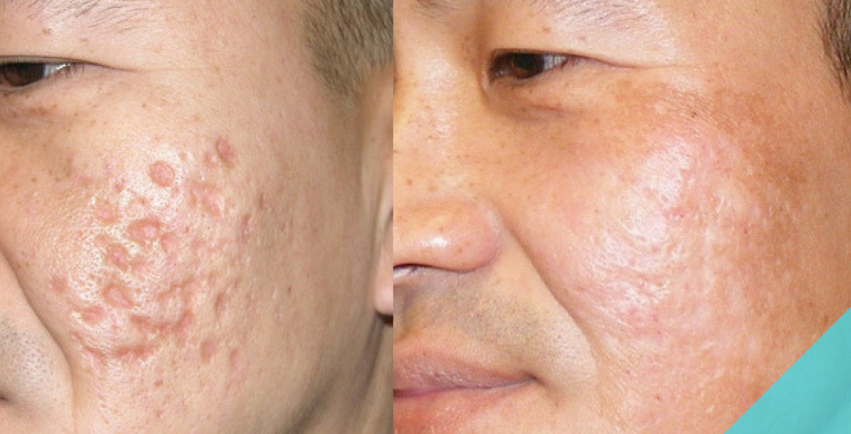 bacne scars treatment