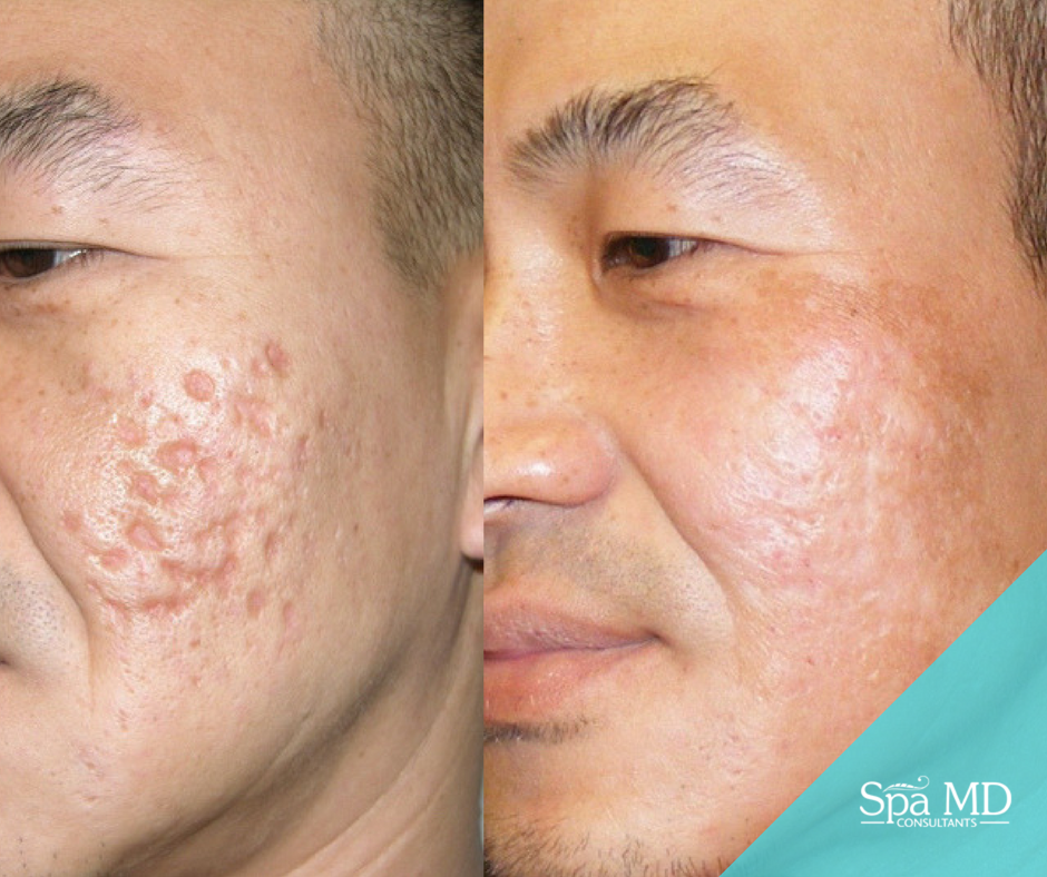 What can you use to get rid of acne scars Treatments For Getting Rid Of Deep Acne Scars Spa Md