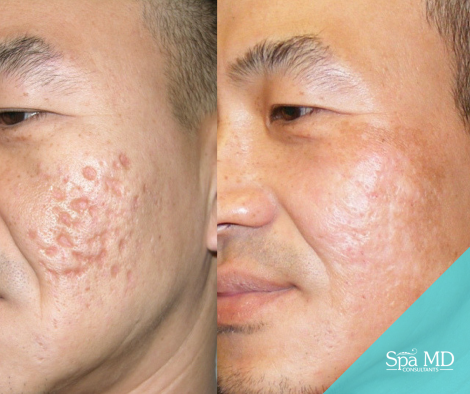 Treatments for Getting Rid of Deep Acne Scars Spa MD