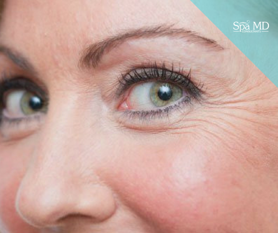 Removing Crows Feet With Botox Spa Md