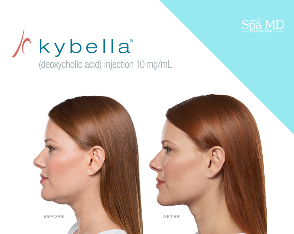 How long does Kybella Last