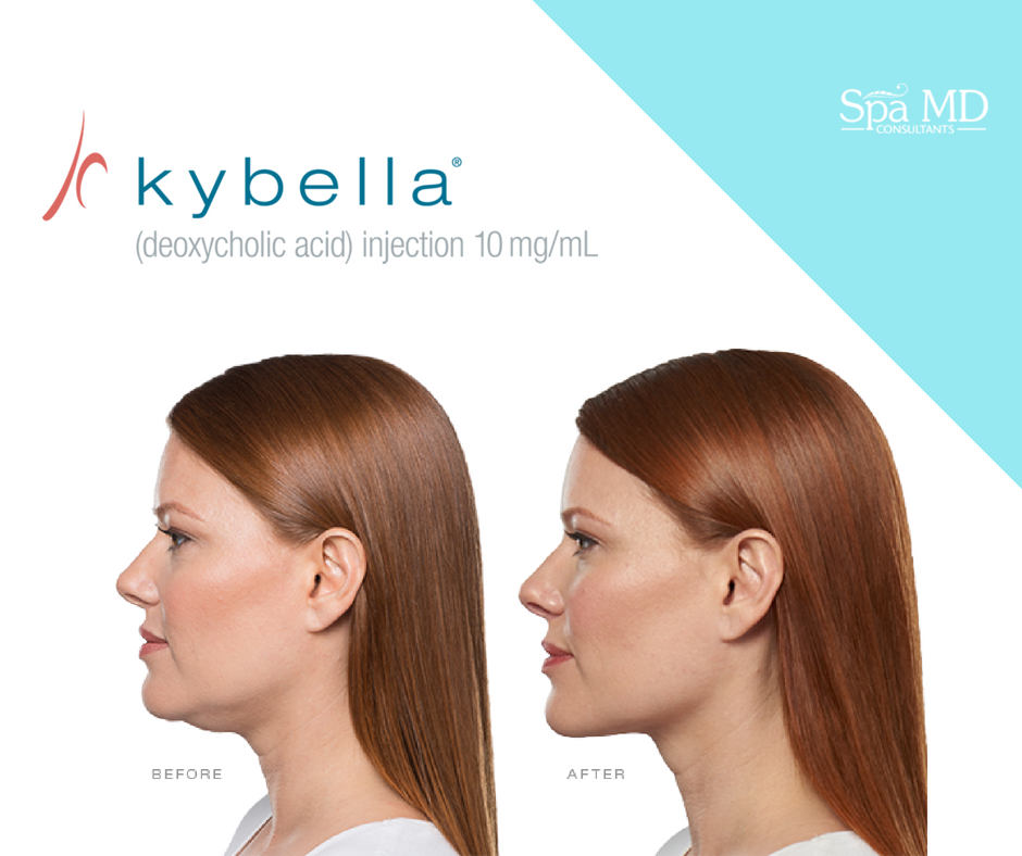 How long does Kybella last? | Spa MD