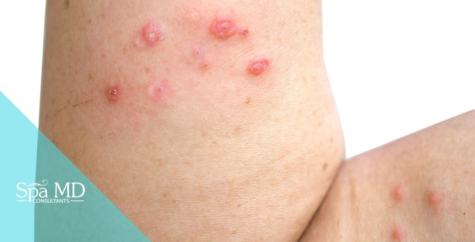 Pictures of common skin rashes, symptoms & treatments