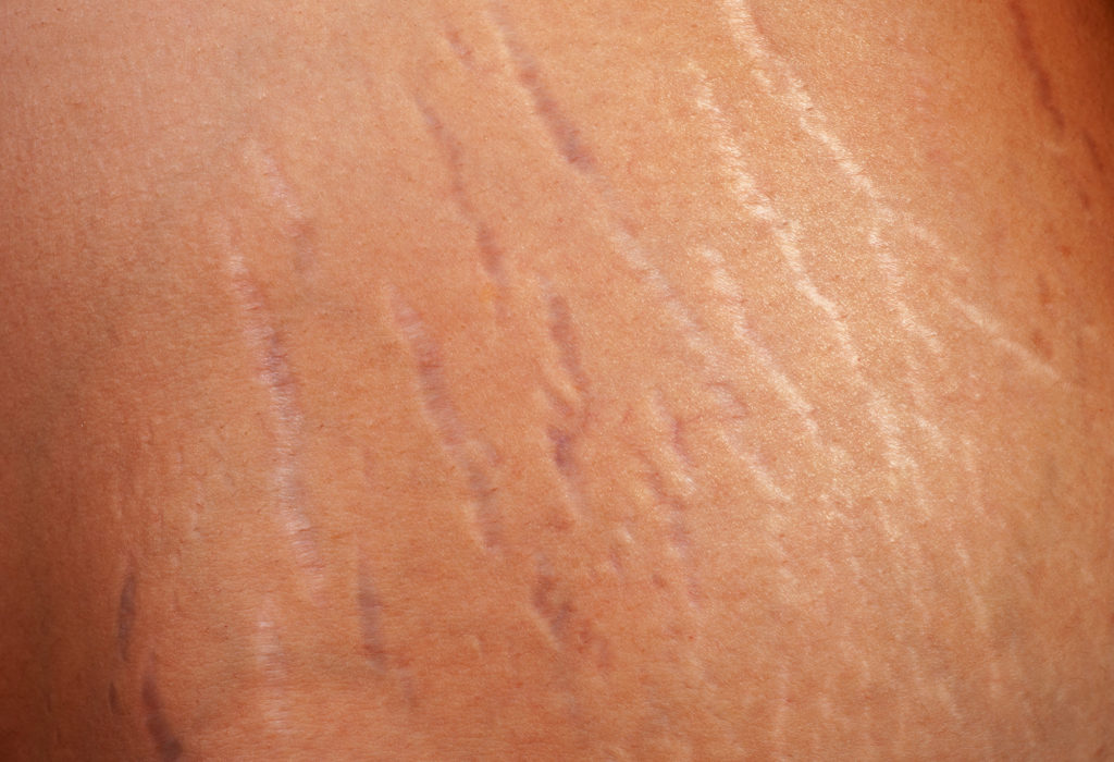 How Do Stretch Marks Happen Spa Md
