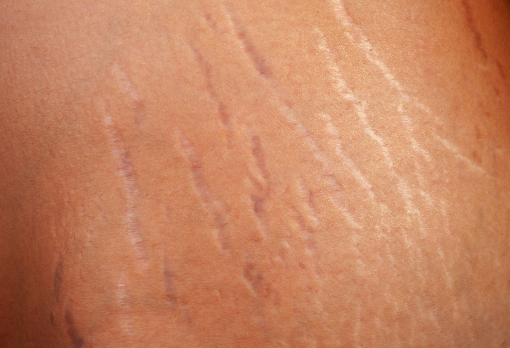 How Do Stretch Marks Happen? - Spa MDSpa MD