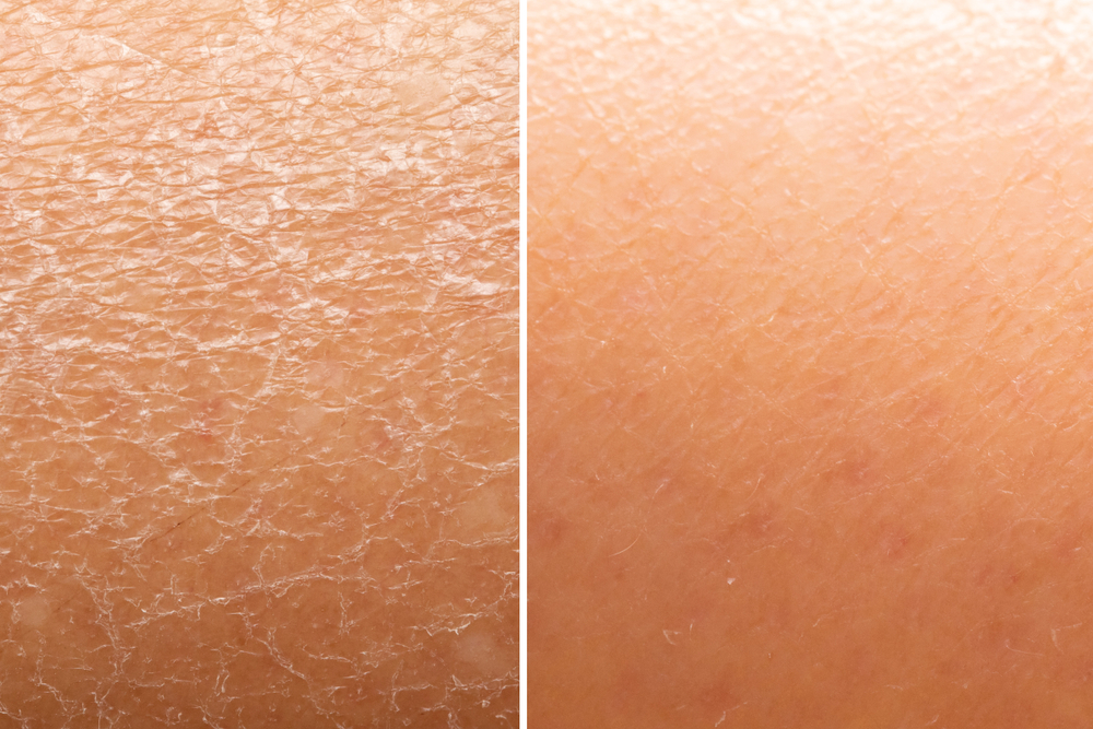 Dry skin vs moisturized skin
