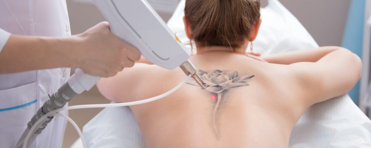 things to consider before tattoo removal
