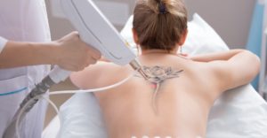 things to consider before tattoo removal