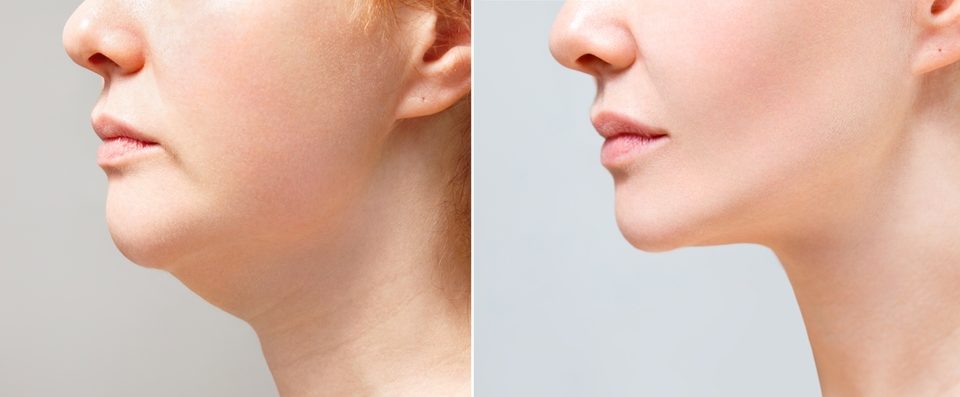 kybella can remove a double chin