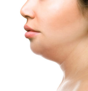 kybella can remove double chin Procedure