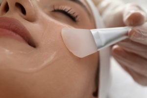 chemical peels help with acne