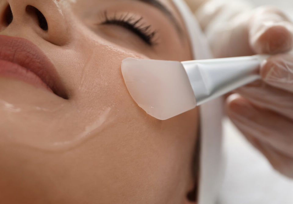 chemical peels help with acne
