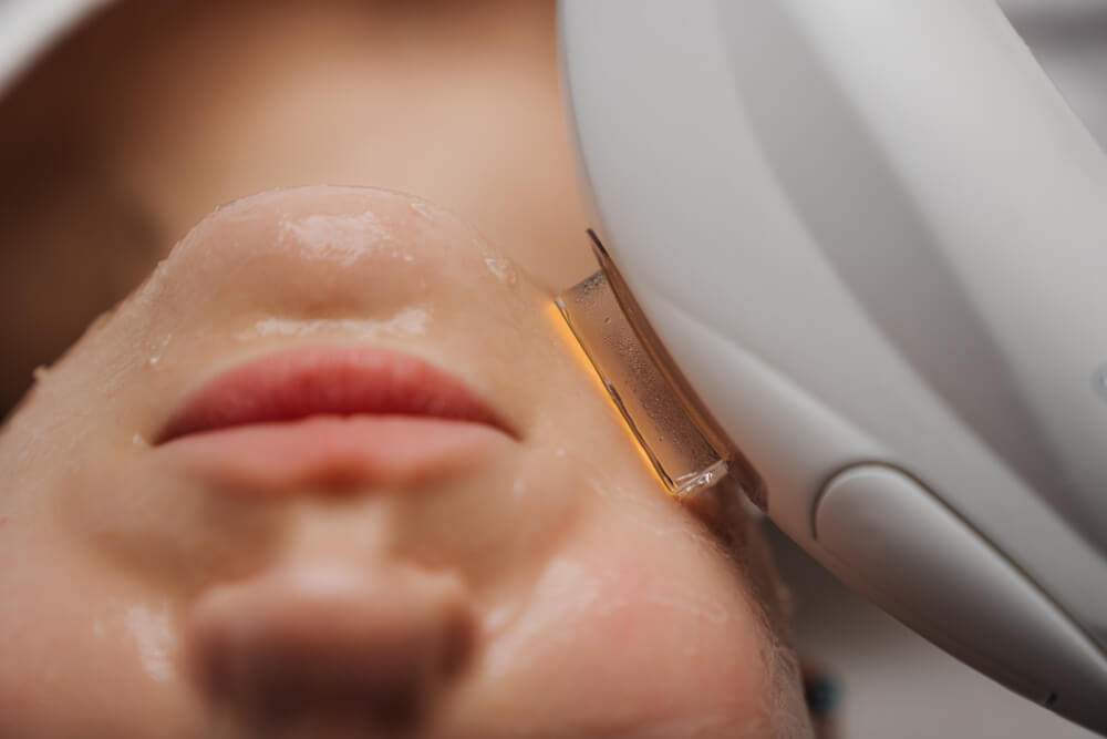 Laser vs. Traditional Skincare: What Makes Laser Treatments Stand Out?