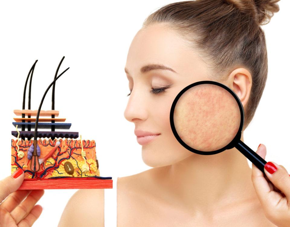 Laser Therapy for Cystic Acne: A New Solution to Severe Breakouts